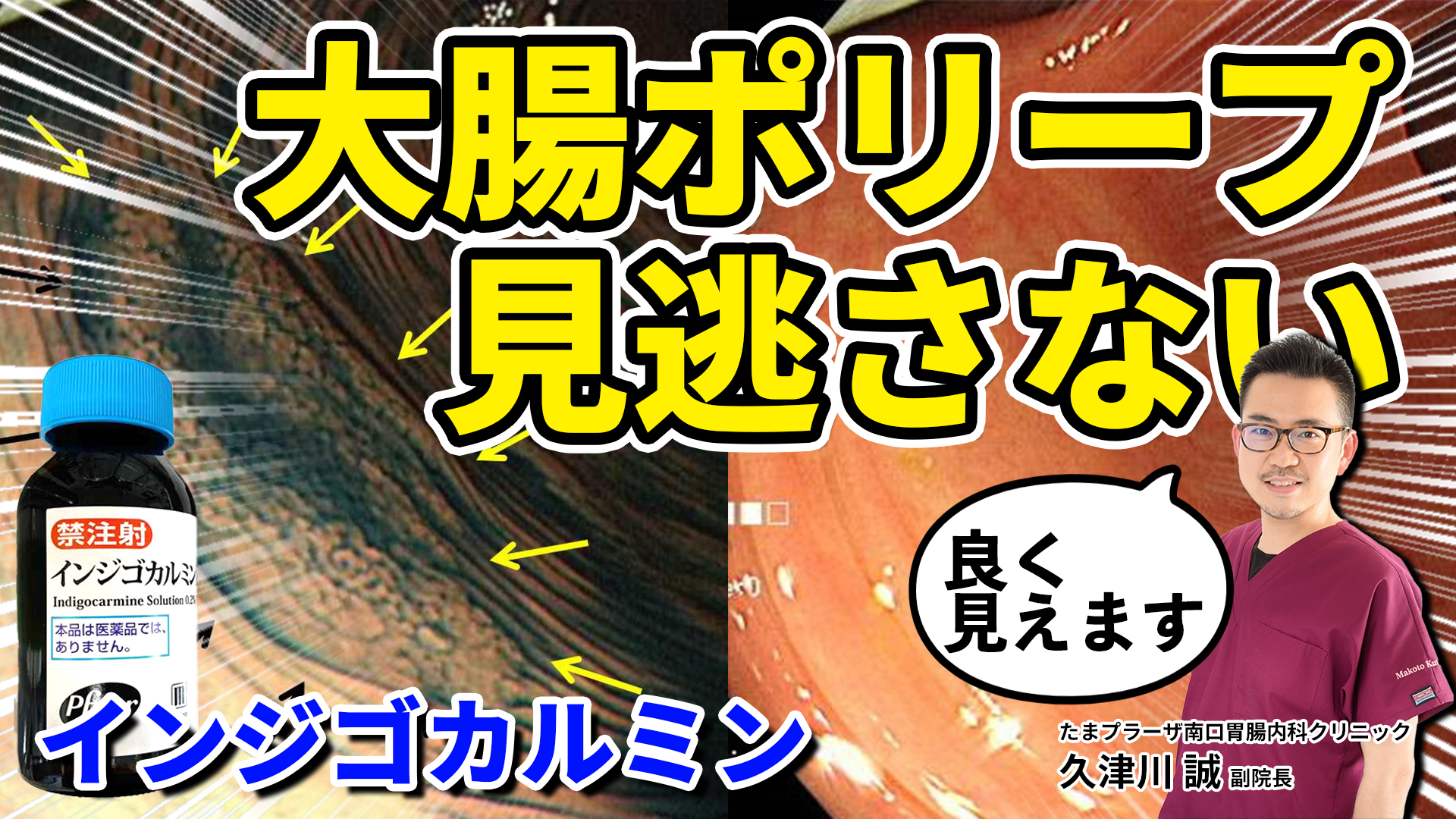 こんなところに大腸ポリープが！？インジゴカルミンで小さなポリープも